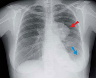 radiothérapie cancer du poumon à petites cellules